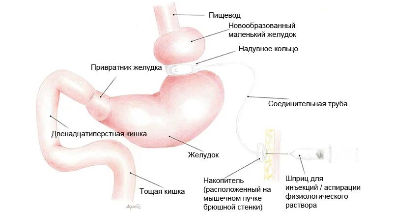 Короткий пищевод. Бариатрическая операция бандажирование желудка. Регулирование бандажирование желудка. Лапароскопическое регулируемое бандажирование желудка. Регулируемое кольцо желудка.