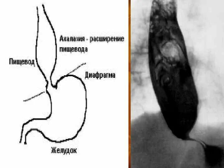 Дилатация пищевода