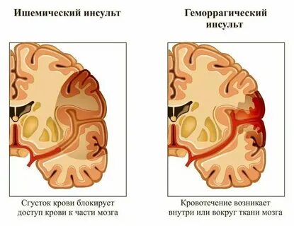 2 типа инсульта