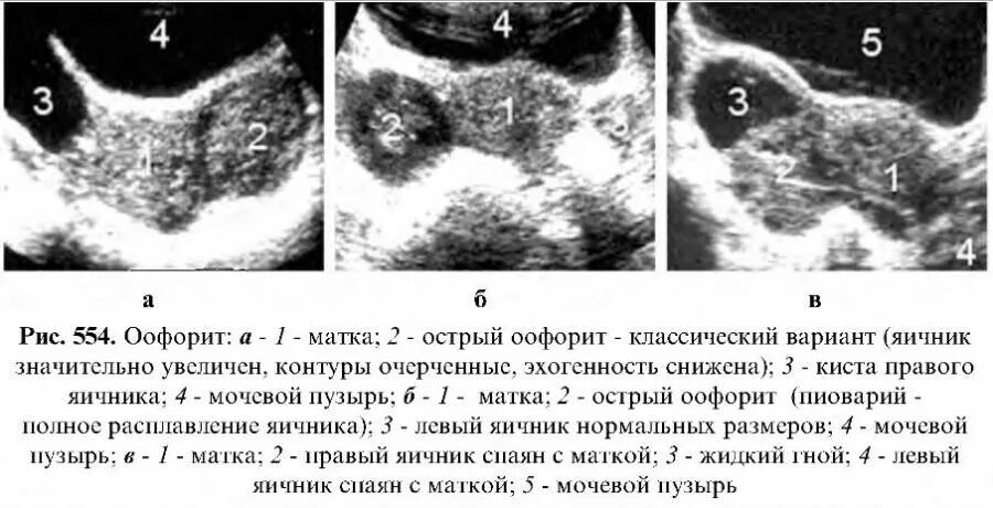 Хронический сальпингоофорит УЗИ. Оофорит по УЗИ признаки. Структурные изменения матки