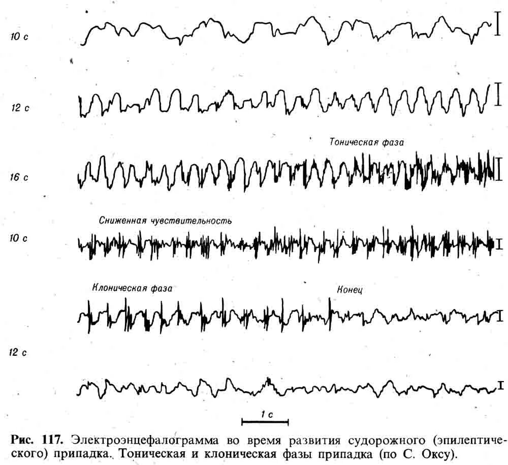 Плохое ээг. ЭЭГ волны патологические. ЭЭГ при эпилепсии расшифровка. Эпилептиформные паттерны на ЭЭГ. ДЭПД на ЭЭГ.