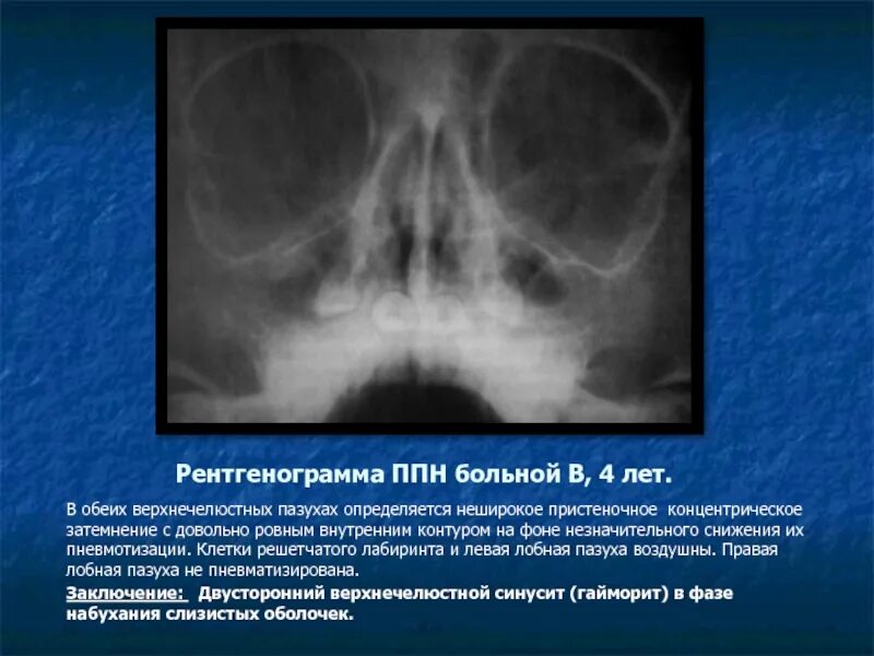 Пневматизированы пазухи носа что значит пневматизированные. Пристеночное затемнение лобных пазух рентген. тотальный верхнечелюстной синусит. пристеночное затемнение верхнечелюстных пазух носа на рентгене.