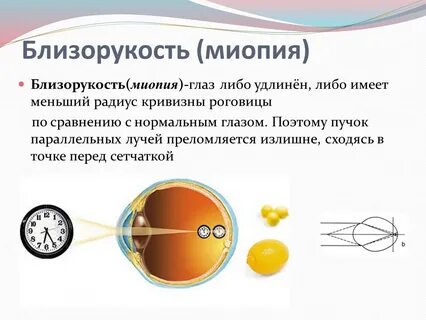 Кривизна глаза