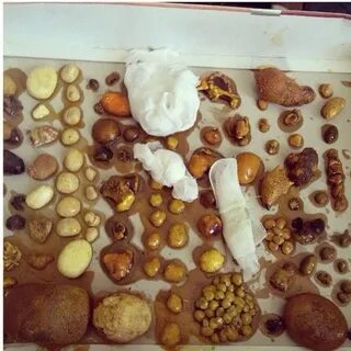 Камни при мочеиспускании