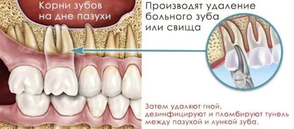 Лечение одонтогенного гайморита