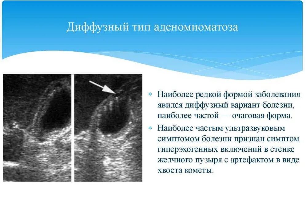 Аденомиоз диффузные изменения