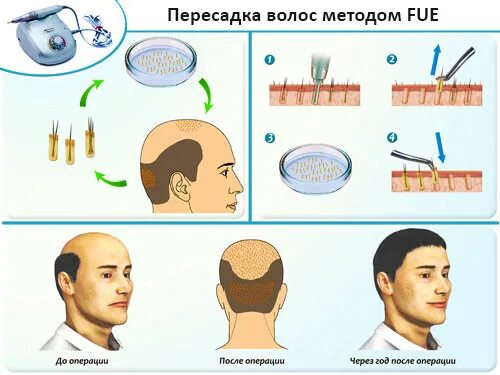 Пересадка 5 часов. Трансплантация волос fue.