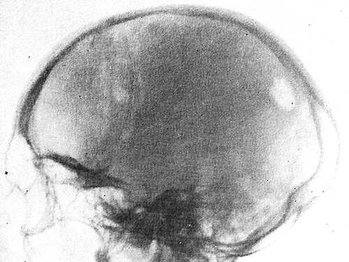 миеломная болезнь рентген черепа. миеломная болезнь поражение костей рентген. деструкция костей миеломная болезнь. миеломная болезнь рентген черепа. деструкция костей черепа рентген.