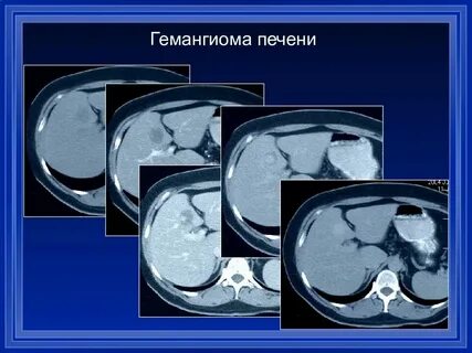 Болит печень гемангиома