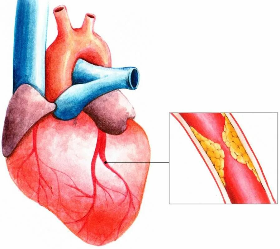 Коронарная ишемия. Стенокардия ишемия сердца. Ишемическая болезнь сердца стенокардия инфаркт миокарда. Острый коронарный синдром и инфаркт миокарда.