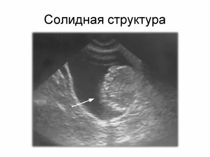 Узи новообразований