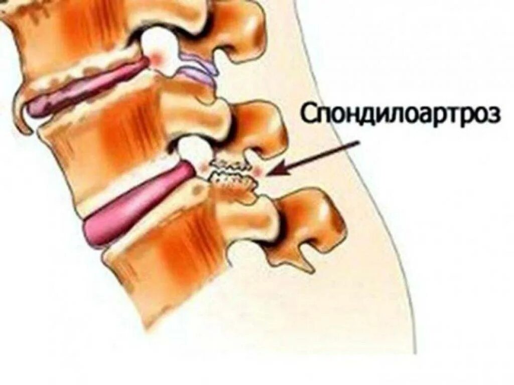 Спондилеза спондилоартроза поясничного отдела позвоночника. Спондилоартроз l3-l5. Спондилоартроз 1-2 шейного отдела. Спондилоартроз пояснично-крестцового отдела позвоночника th12 s1. Спондилоартроз с4 th1.