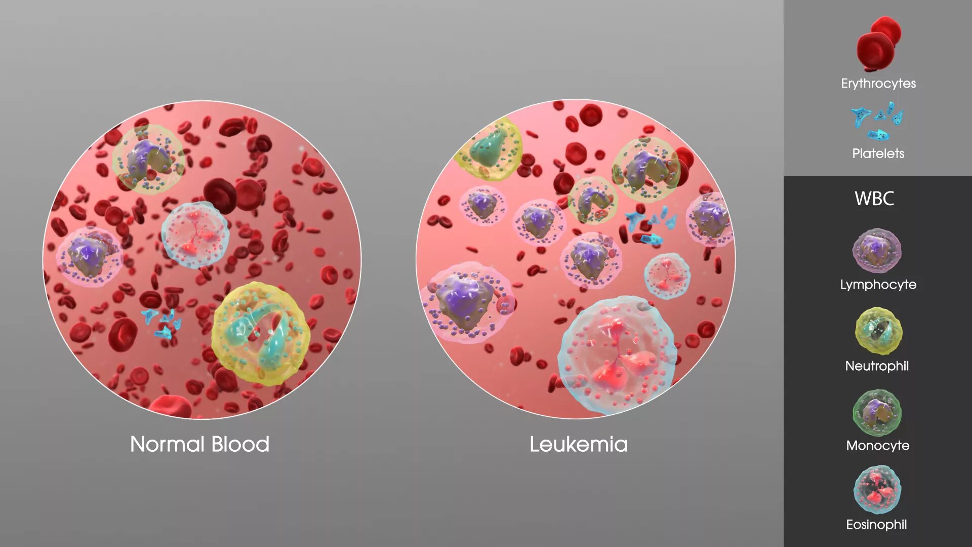 Leukemia. Leukemia
