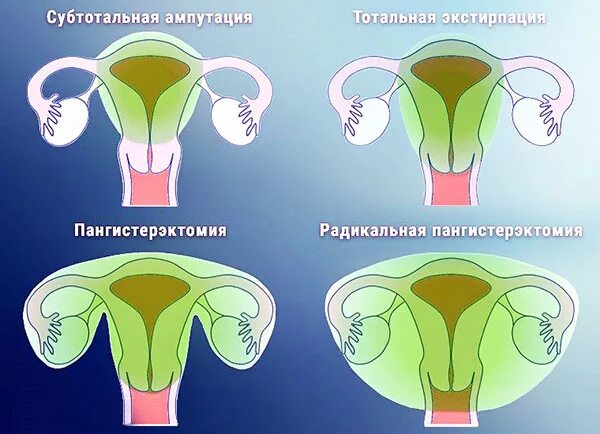 Удаление матки придатков и шейки матки. Ампутация и экстирпация матки отличия. матка экстирпация матки. экстирпация матки (тотальная гистерэктомия).