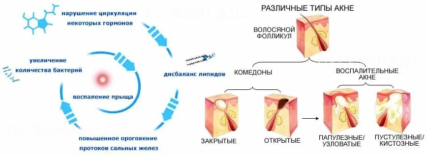 Схема лечения угревой сыпи антибиотиками. Мазь антибиотик против угрей. Дерматокосметология книги. Делекс акне форте гель. Схема лечения угревой сыпи.