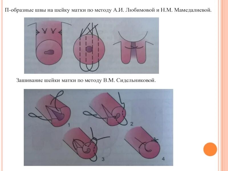 Снять швы с шейки. П образный шов на шейку матки. накладывание швов на шейку матки при беременности. круговой шов на шейку матки. двойной п образный шов шейки матки.