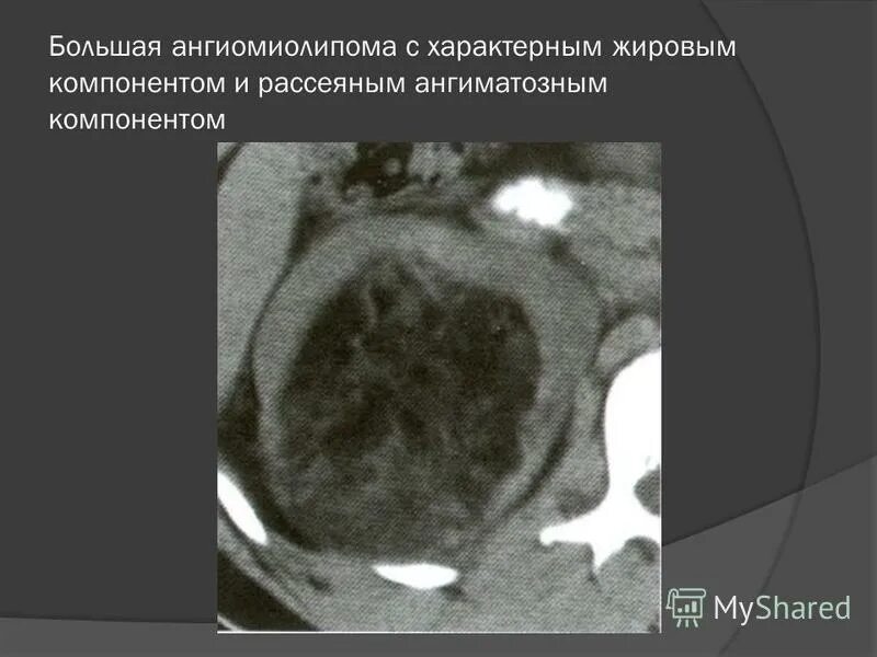 что такое ангиомиолипома