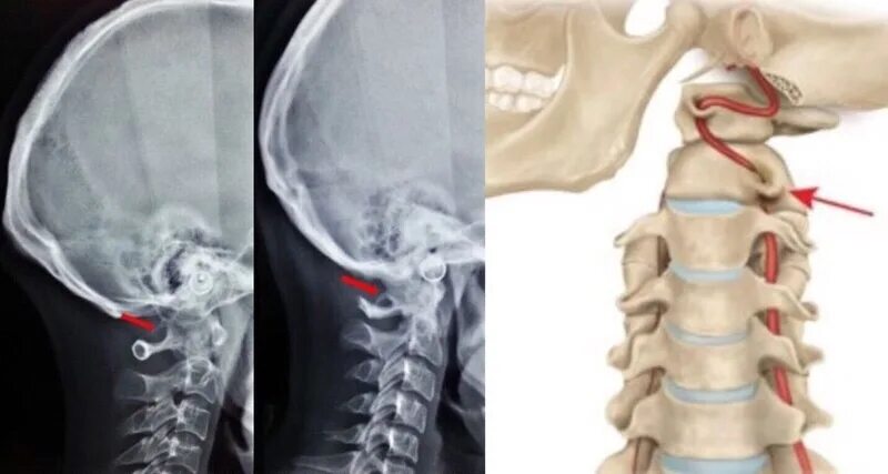 Аномалия киммерли с1 позвонка что это такое. Аномалия киммерле с1. Неполная аномалия киммерли с1 позвонка. Неполная аномалия киммерли с1. Аномалия киммерли снимки.