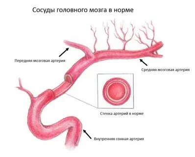 Хрупкие сосуды
