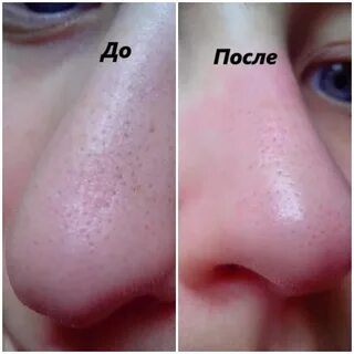 Поры после чистки