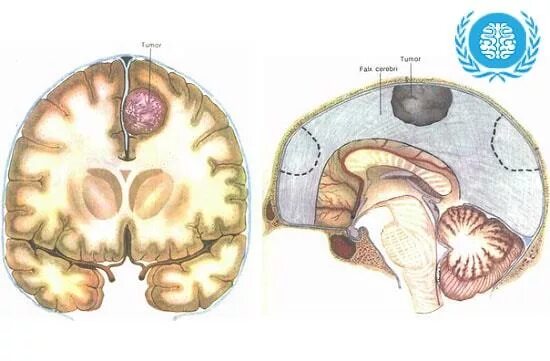 Менингиома парасагиттальная лобной доли. Менингиома серпа большого мозга. Атипическая менингиома. После операции менингиомы головного мозга