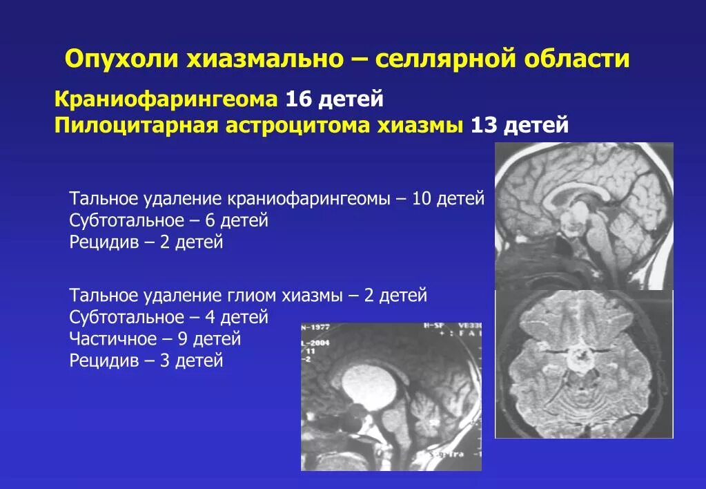 Объемное образования мозга мкб. Опухоли селлярной области мрт. Патология хиазмально-селлярной области. Объемное образование в хиазмально-селлярной области. Опухоль в области хиазмы.