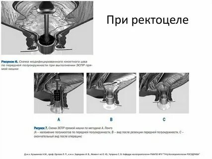 Цистоцеле и ректоцеле