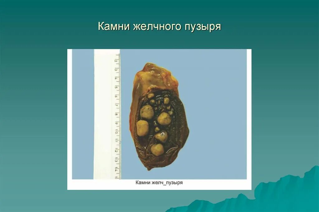 Камни желчного пузыря патанатомия. Конкременты желчного пузыря что это такое. Камн и в желечном пузыре. Конркемет желчного пузыр.