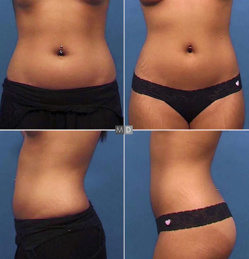 Ультразвуковой липолиз до после. Липолитики в зону галифе. 20 мл липолитик фат. Убрать живот липолитиками. Липолитики в живот синяки.