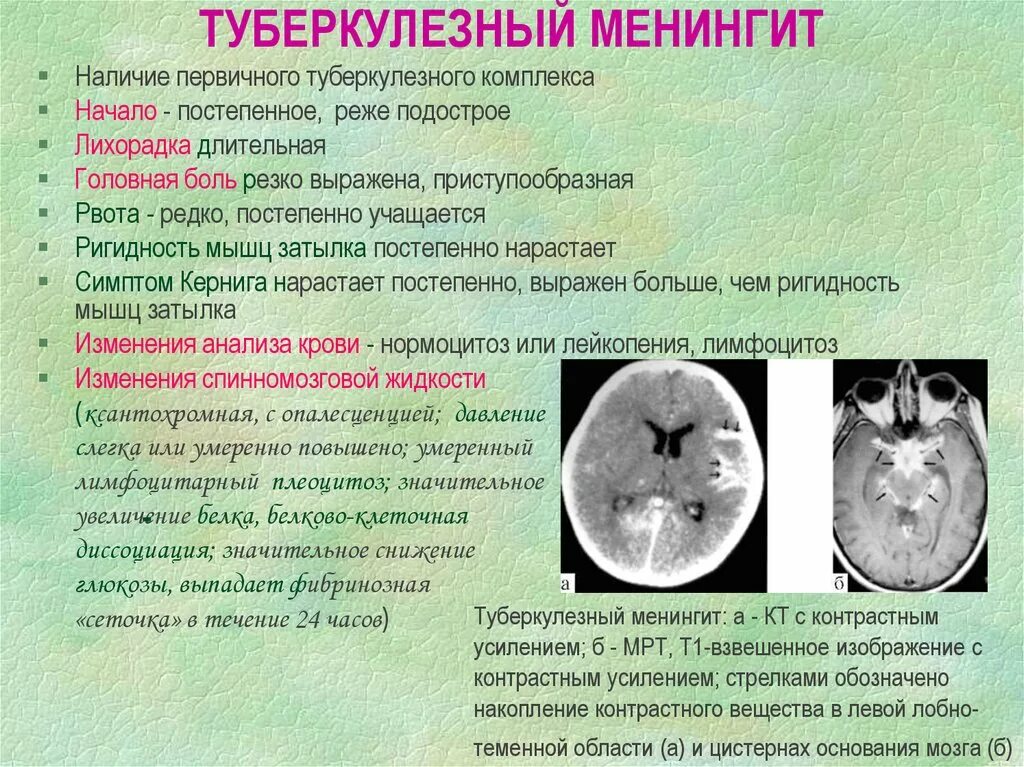 Туберкулез мозговых оболочек кт. Туберкулезный менингоэнцефалит кт. Туберкулёз мозговых оболочек и ЦНС диагностика. Клинические симптомы туберкулезного менингита.