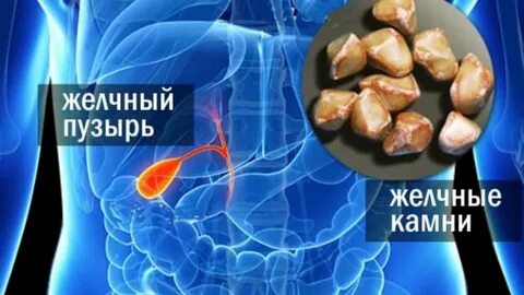 Желчно каменный болезнь