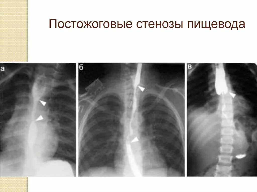 Рубцовые сужения пищевода