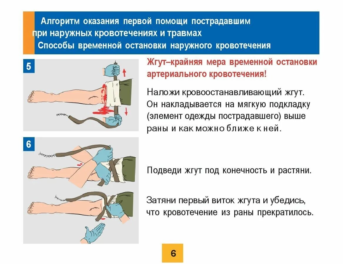 Технику наложения жгута на конечности. Наложение жгута Эсмарха при артериальном кровотечении. Методика наложения жгута Эсмарха. Как накладывать жгут при артериальном кровотечении. Наложение жгута при артериальном кровотечении алгоритм.