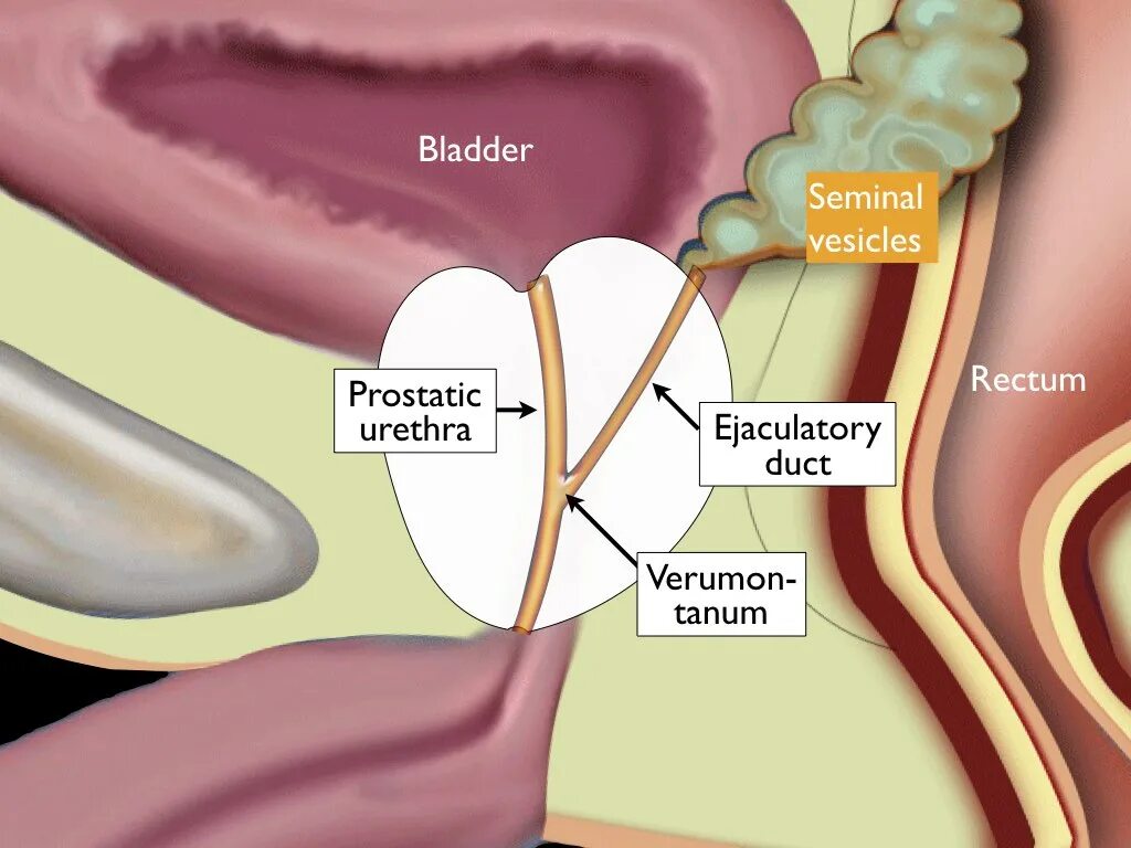 Везикулит симптомы и лечение у мужчин. Семенной бугорок уретры. Семенной бугорок анатомия. Семенной бугорок предстательной железы.