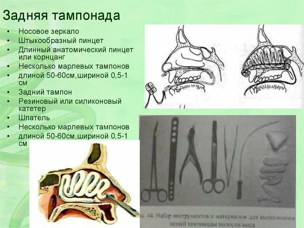 Тампонада носа при носовом кровотечении. Задняя тампонада носа алгоритм. Набор для передней тампонады носа. Набор инструментов для задней тампонады носа. Передняя и задняя тампонада носа.