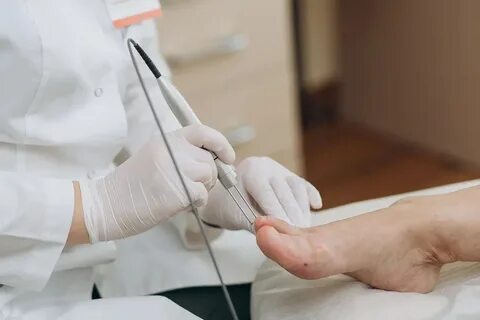 Грибок ногтей лазерная