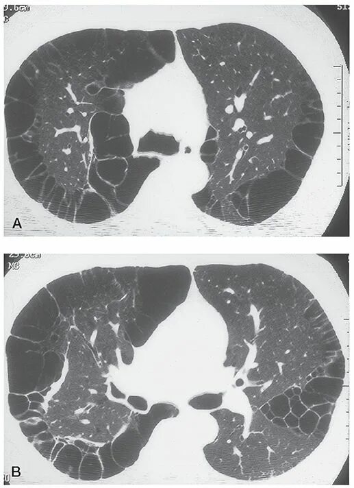 Диффузный пневмосклероз это рак. Парасептальная эмфизема легких на кт. Бронхиолоэктатическая эмфизема. Диффузный пневмосклероз кт. Диффузный пневмосклероз легких на кт.