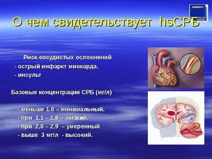 Инсульт миокарда