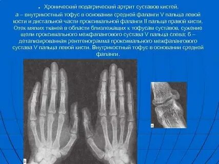 Застарелый подвывих