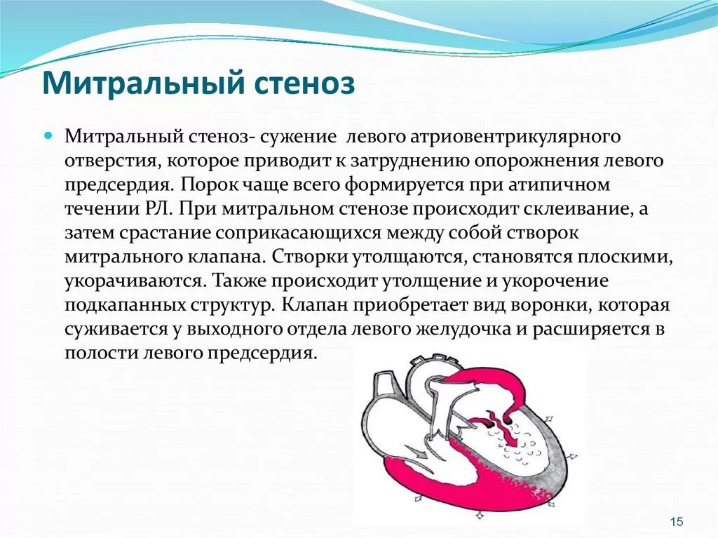 Относительный митральный стеноз. Приобретенные пороки сердца митральный стеноз. Стеноз митрального клапана сердца. Пороки сердца митральный стеноз. Патологическая анатомия митральной недостаточности.