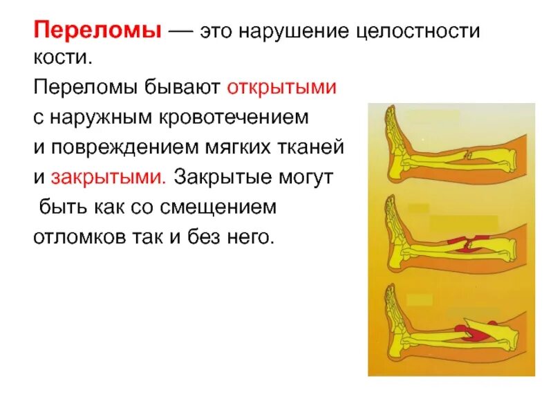 Перелом костей предплечья рентген. Переломы пястных костей кисти классификация. Перелом глазничной поверхности скуловой кости. Какие кости легко сломать. Перелом 1 пястной кости большого пальца.