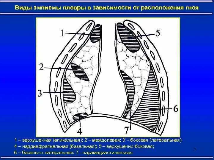 Плеврит эмпиема плевры. Хроническая эмпиема плевры операции. Эмпиема плевральной полости. Полость эмпиемы. Методы лечения эмпиемы плевры.