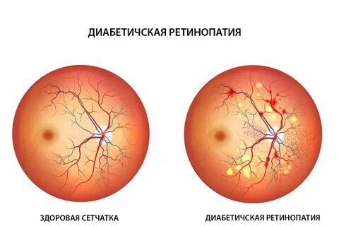 Диабетическая ретинопатия симптомы