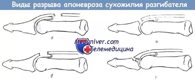 Разрыв сухожилия разгибателя кисти. Разрыв сухожилия разгибателя ногтевой фаланги. разрыв сухожилия разгибателя 3 пальца кисти. подкожный отрыв сухожилия разгибателя пальца. травма дистальная фаланга пальца руки.