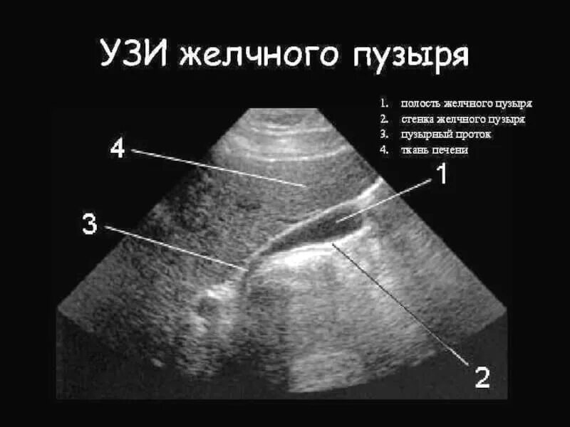 Определение сократимости желчного пузыря. УЗИ сократимости желчного пузыря. Функция желчного пузыря на УЗИ. Сократимость желчного пузыря УЗИ протокол. Эхограмма желчного пузыря.