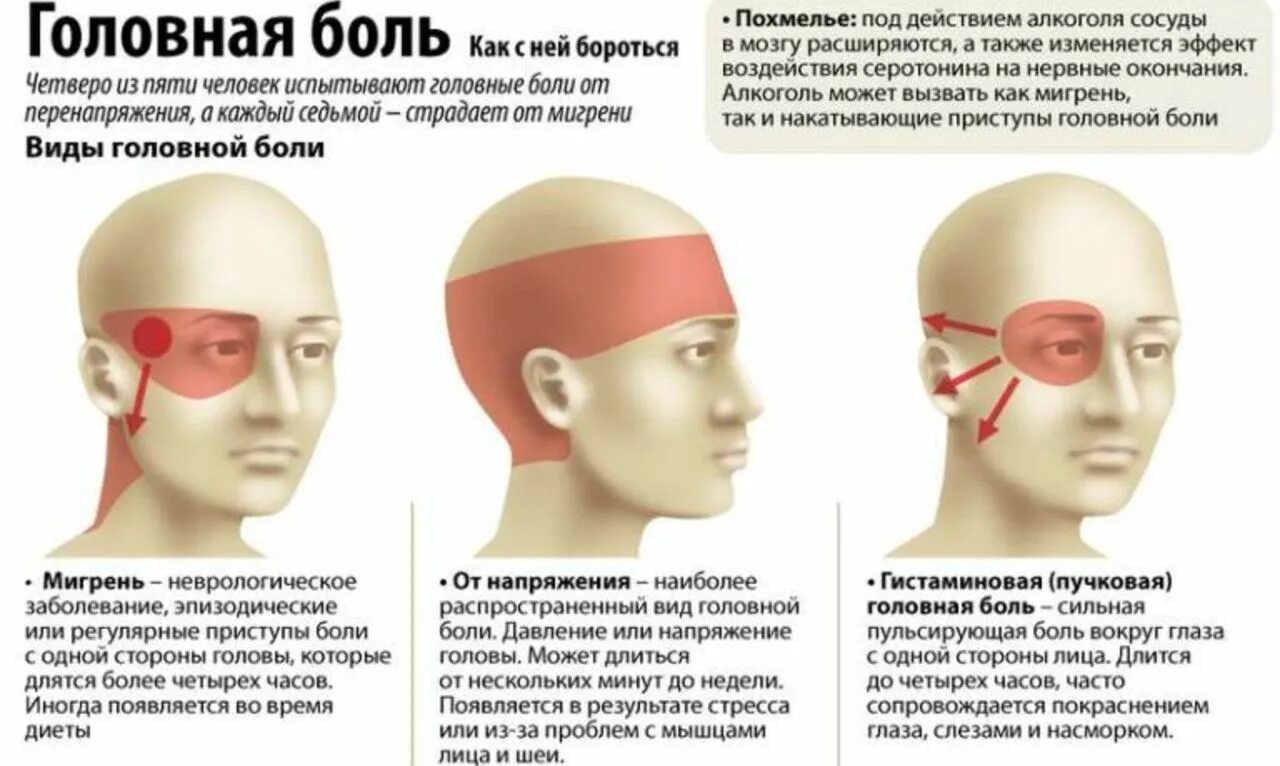 Частые головные боли диагноз. Виды головной боли. Локализация глазной боли. Боль в висках головы. Мигрень и головная боль напряжения.