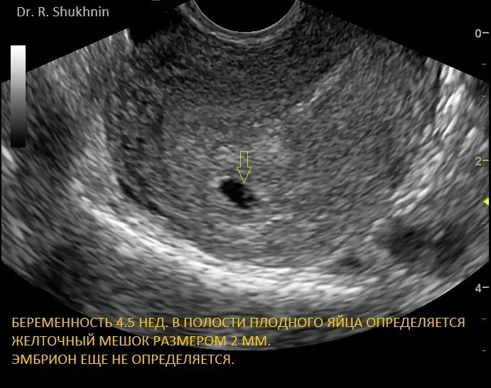 Плодное яйцо 16мм,эмбрион 6мм. Плодное яйцо 7 мм желточный мешок 6 мм. Плодное яйцо 3мм и желточный мешок 3мм. Плодное яйцо 8 мм желточный мешок 16 мм.