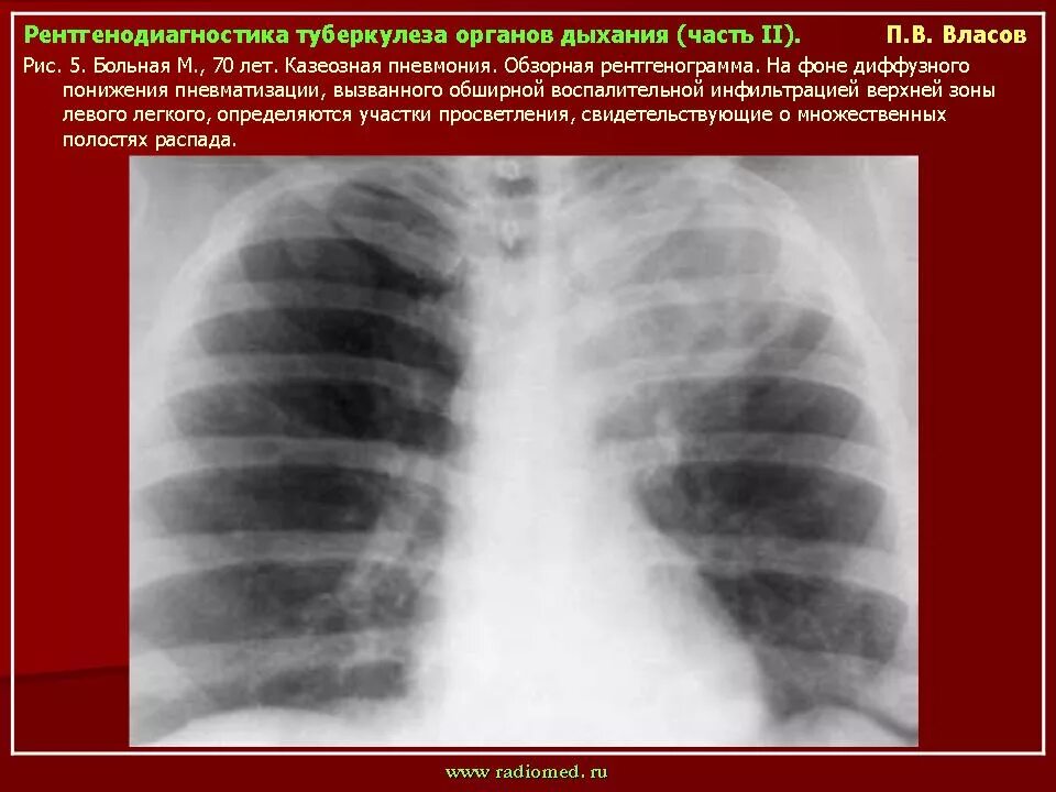 Клинический случай туберкулез. Казеозная пневмония туберкулез рентген. Лобарная казеозная пневмония. Лобарная кавернозная пневмония. Лобарная казеозная пневмония туберкулез.