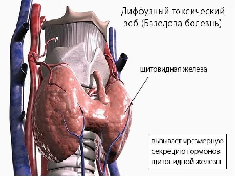 Зоб пищевода