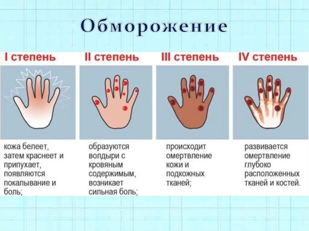 Признак отморожения 2 стадии. Холодовая травма классификация отморожение. Клинические проявления поверхностного отморожения 1 и 2 степени. Степени отморожения таблица.